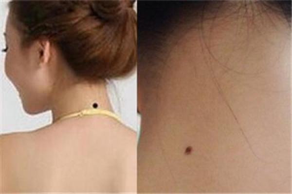 颈部后方的痣类型解析 脖颈后部痣的含义探究