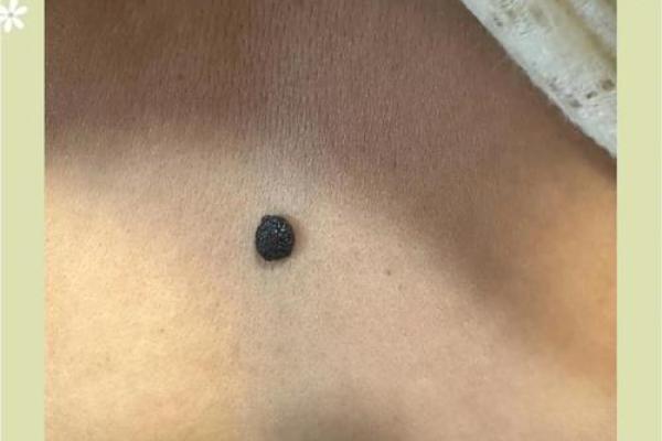 探究男性鼻梁痣的吉凶：不同位置痣点所代表的含义解析