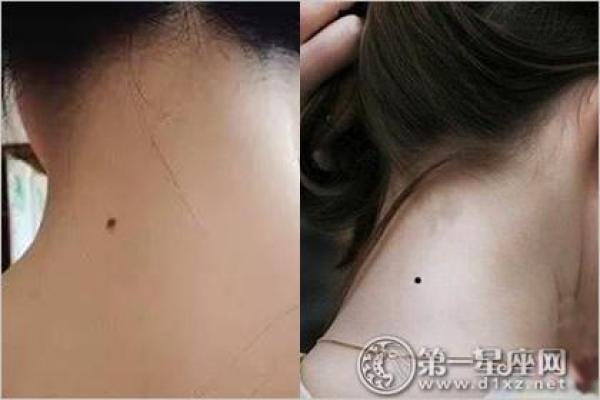 探究苦情痣与命运关联：解析苦情痣生长位置及其影响