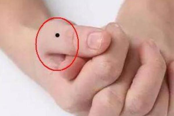 不同手指痣的含义解析：揭秘手指长痣的象征意义