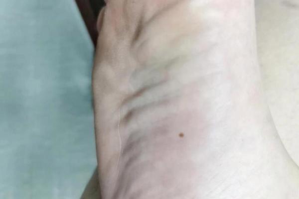 脚底痣相解析：命运如何及有痣者的生活趋向