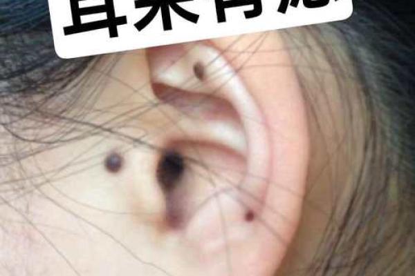 右耳痣为旺夫标志：揭秘女性的助夫好运痣